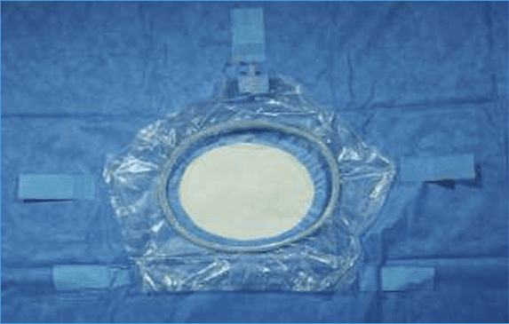 Neuro Surgery Drapes